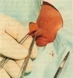 Tissue scissors are used to cut the dorsal slit through the middle of the crushed area.