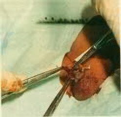 Excision of the prepuce.  Excess foreskin is trimmed from around the bell using an iris scissors.